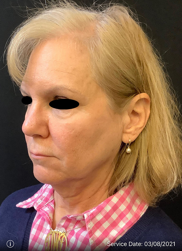 Facelift