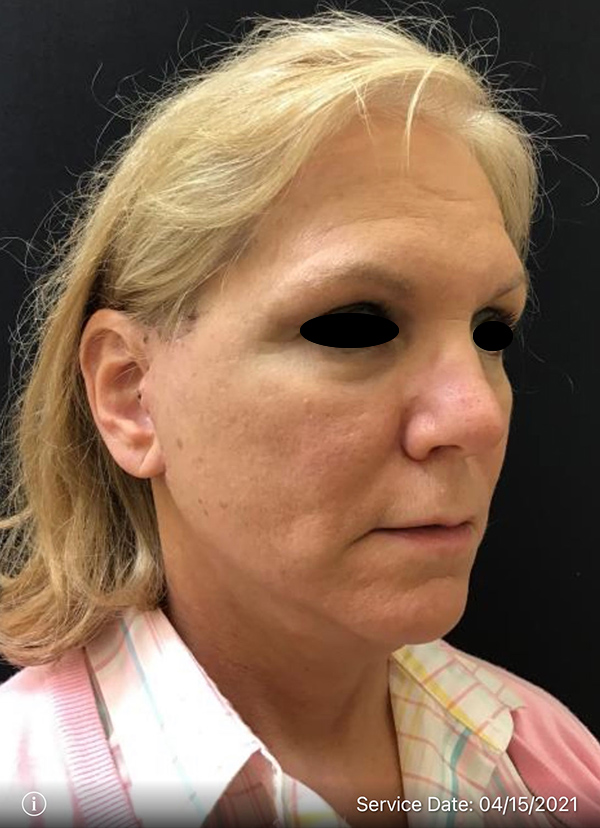 Facelift