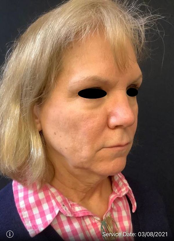 Facelift
