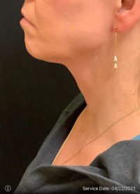 Facetite