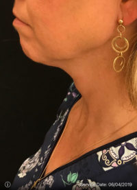 Facetite