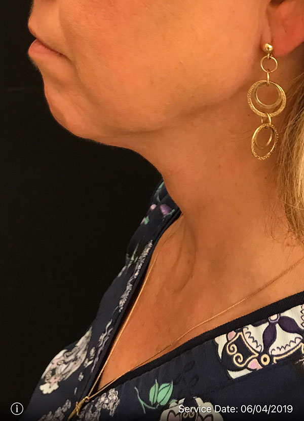 Facetite