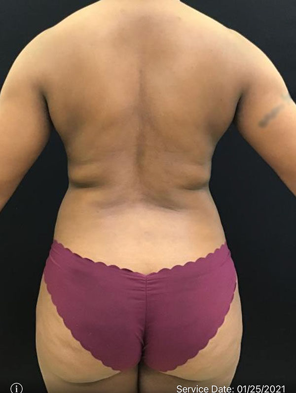Fat Grafting to Breast