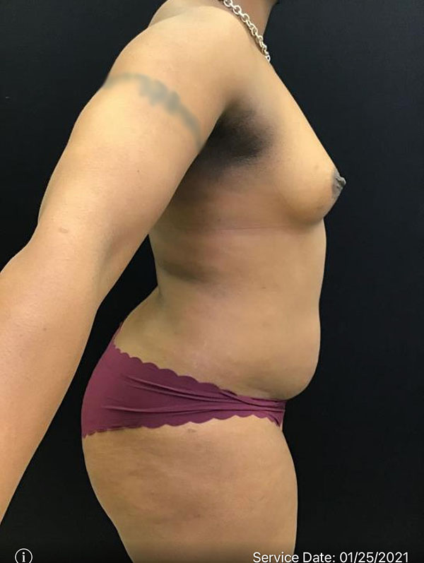 Fat Grafting to Breast