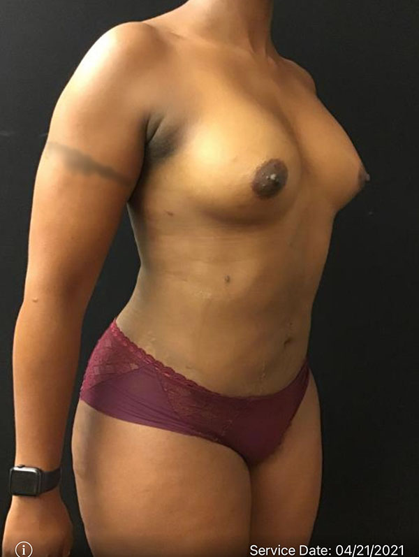Fat Grafting to Breast