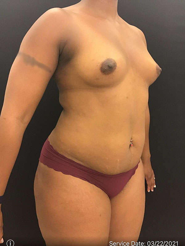 Fat Grafting to Breast