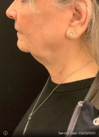 Facelift