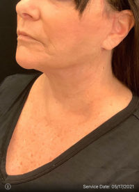 Facelift