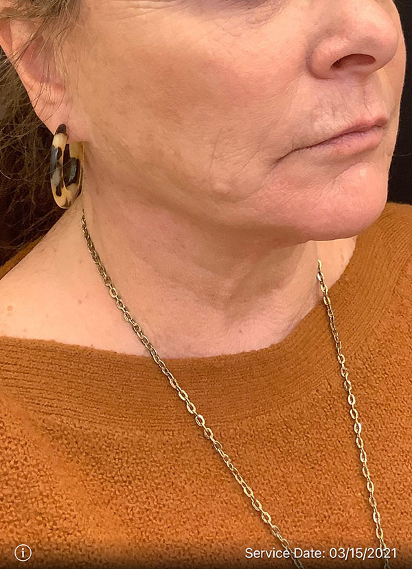 Facelift