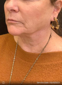 Facelift