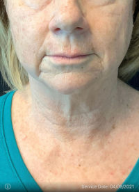 Facelift