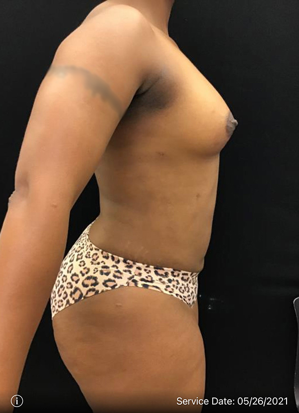 Fat Grafting to Breast