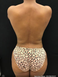 Fat Grafting to Breast