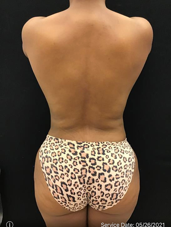 Fat Grafting to Breast