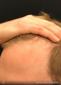 NeoGraft