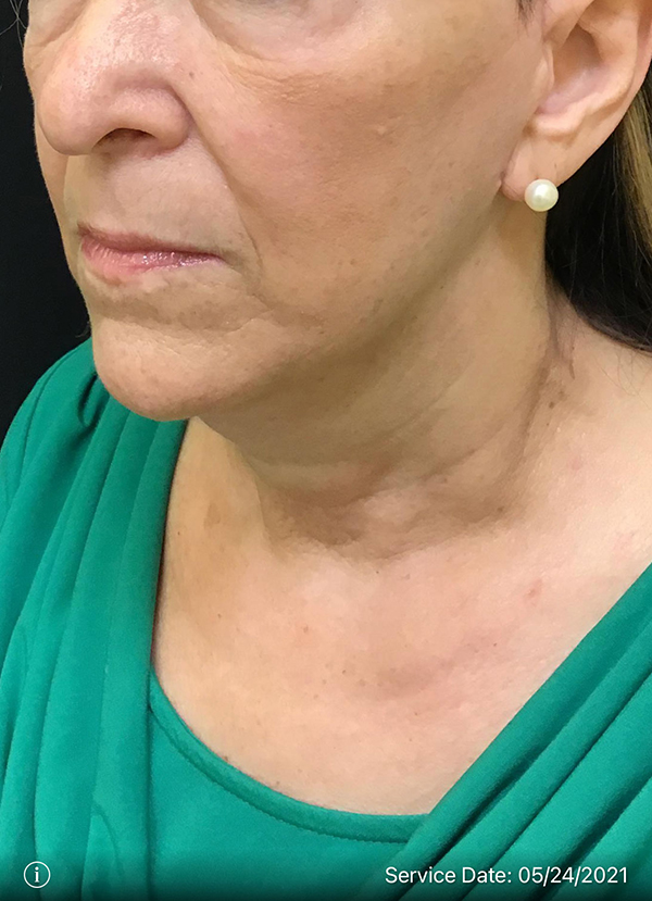 Facelift