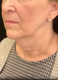 Facelift