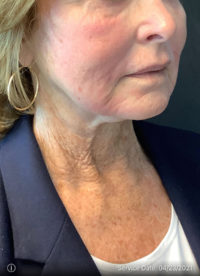 Facelift