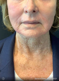 Facelift