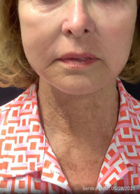 Facelift