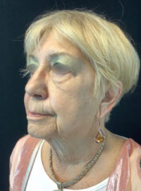 Facelift