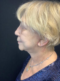 Facelift
