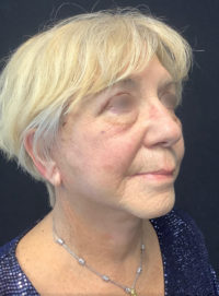 Facelift