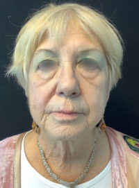 Facelift