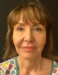 Facelift