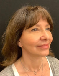 Facelift