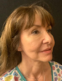 Facelift