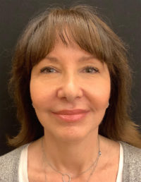 Facelift