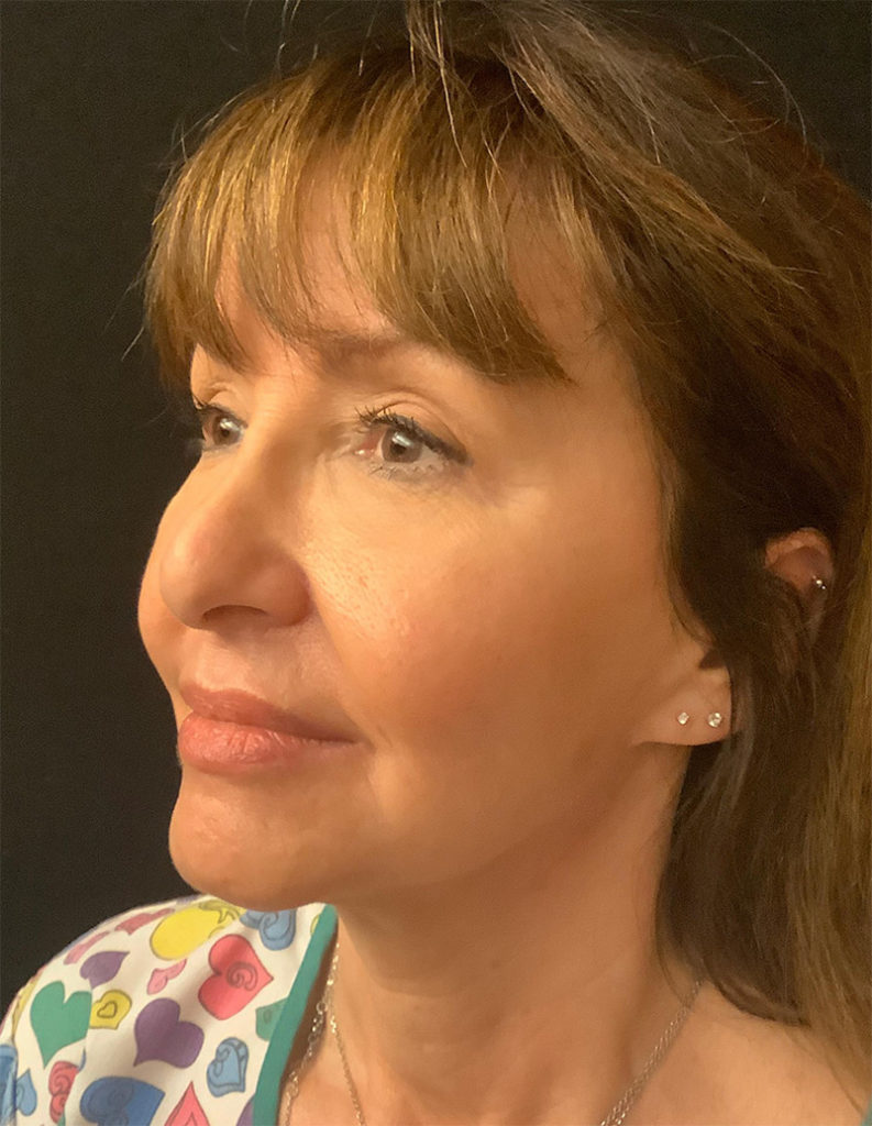 Facelift