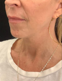 Facelift