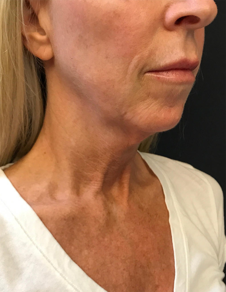 Facelift