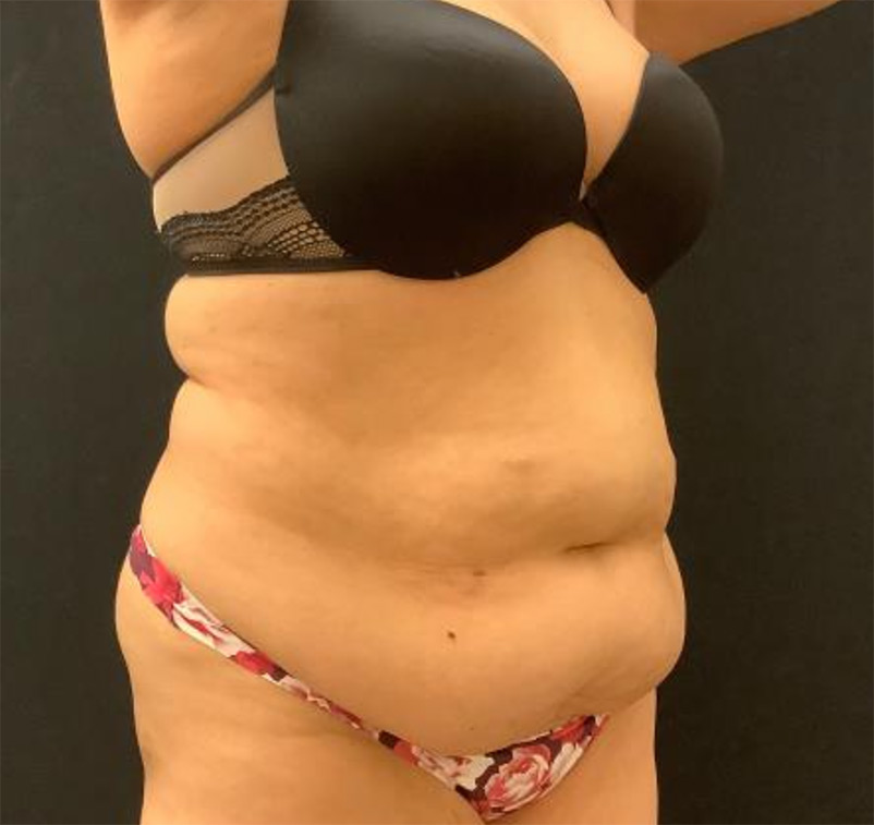 Fat Grafting to Breast