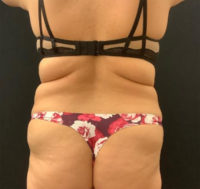 Fat Grafting to Breast