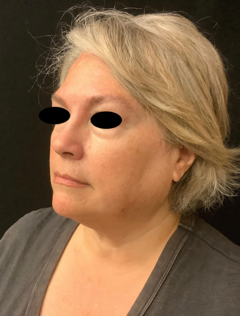 Incisionless Necklifts