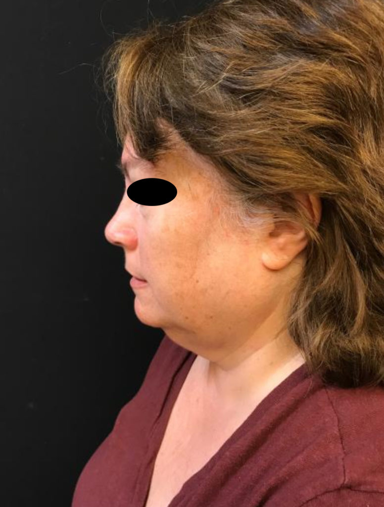 Incisionless Necklifts