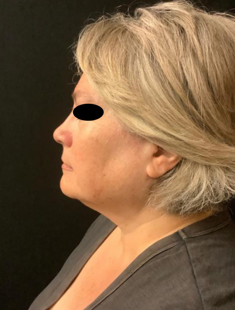 Incisionless Necklifts