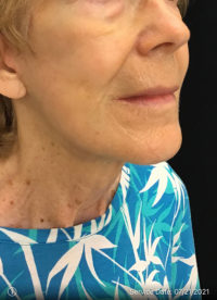 Facelift
