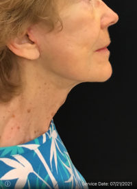 Facelift