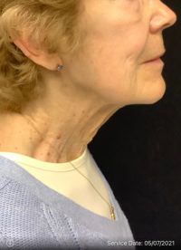 Facelift