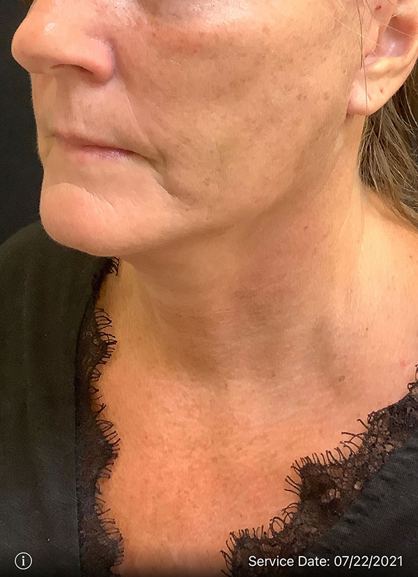 Facelift