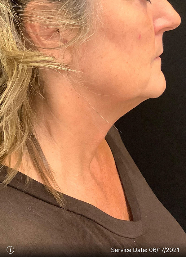 Facelift
