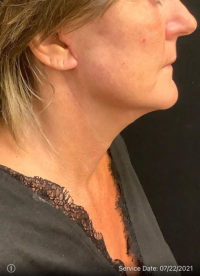 Facelift