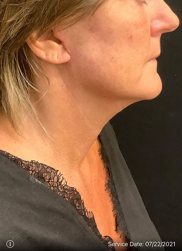 Facelift
