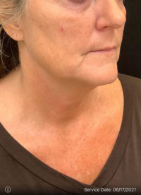 Facelift