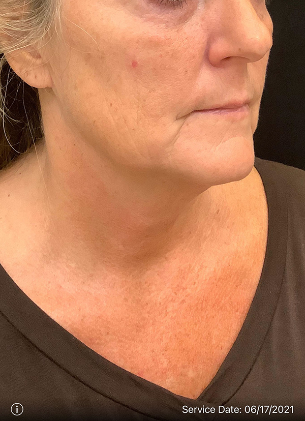 Facelift