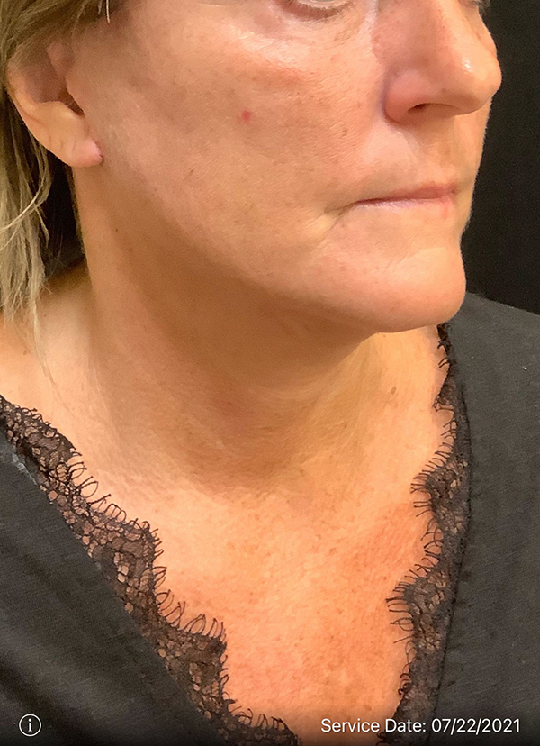 Facelift